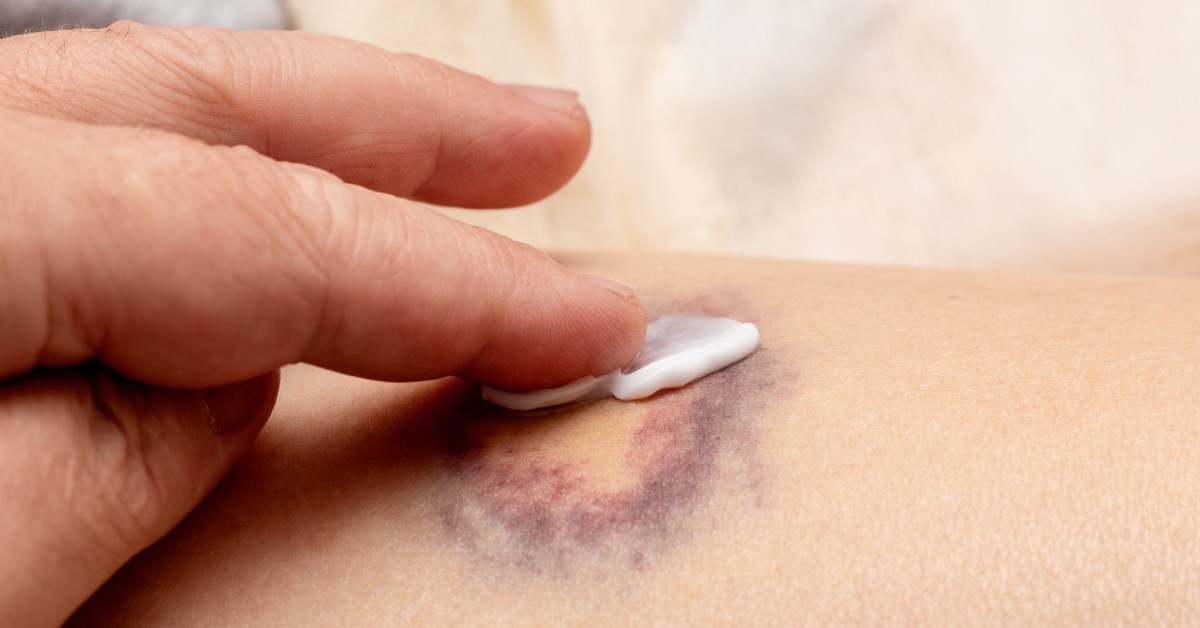 modrica na telu, leukemija