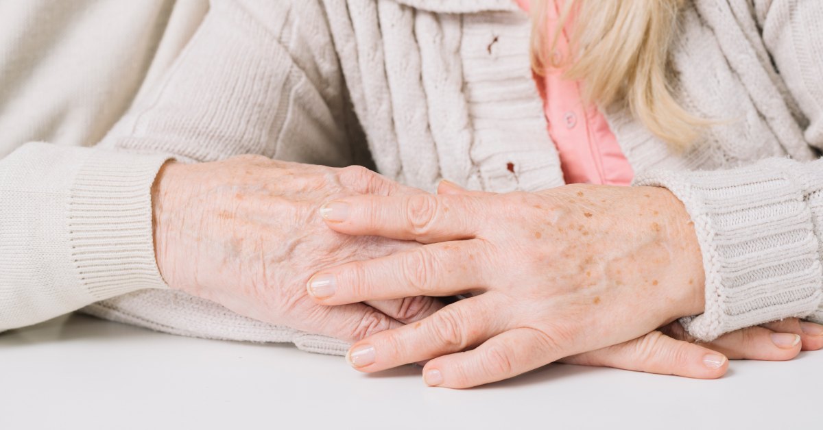 koža šake sa hiperpigmentacijom