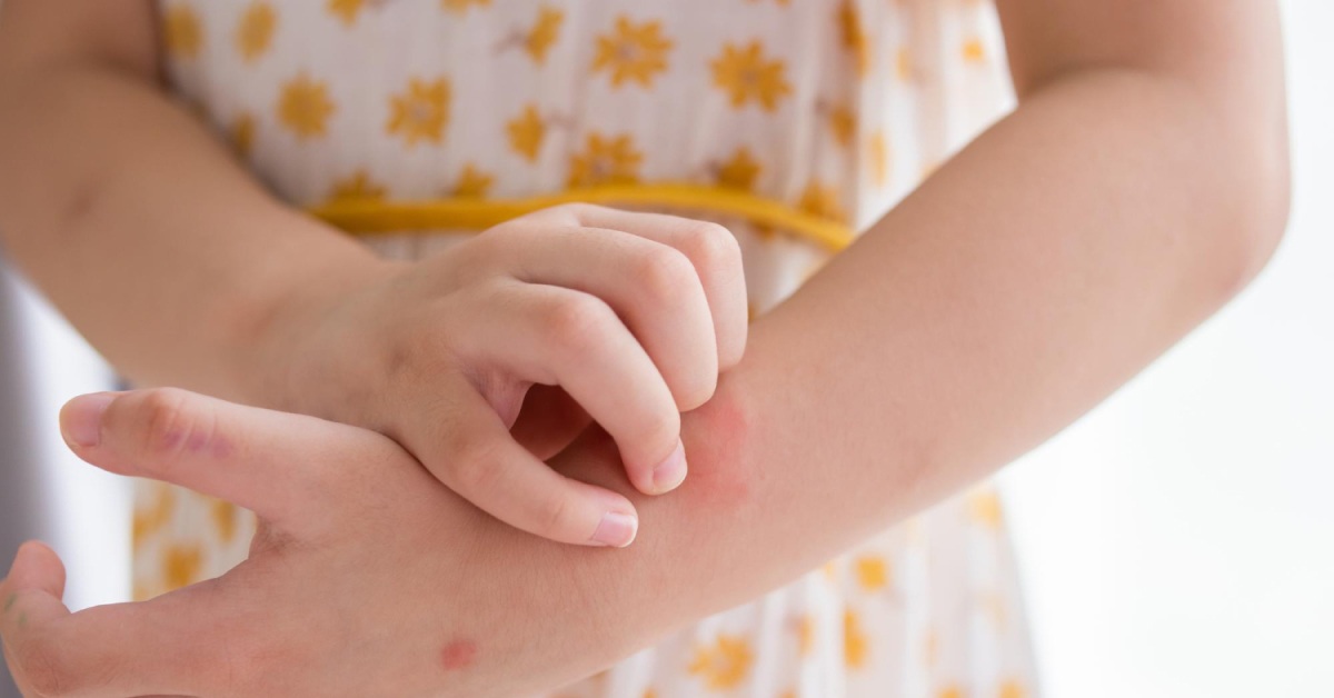 atopijski dermatitis kod djece