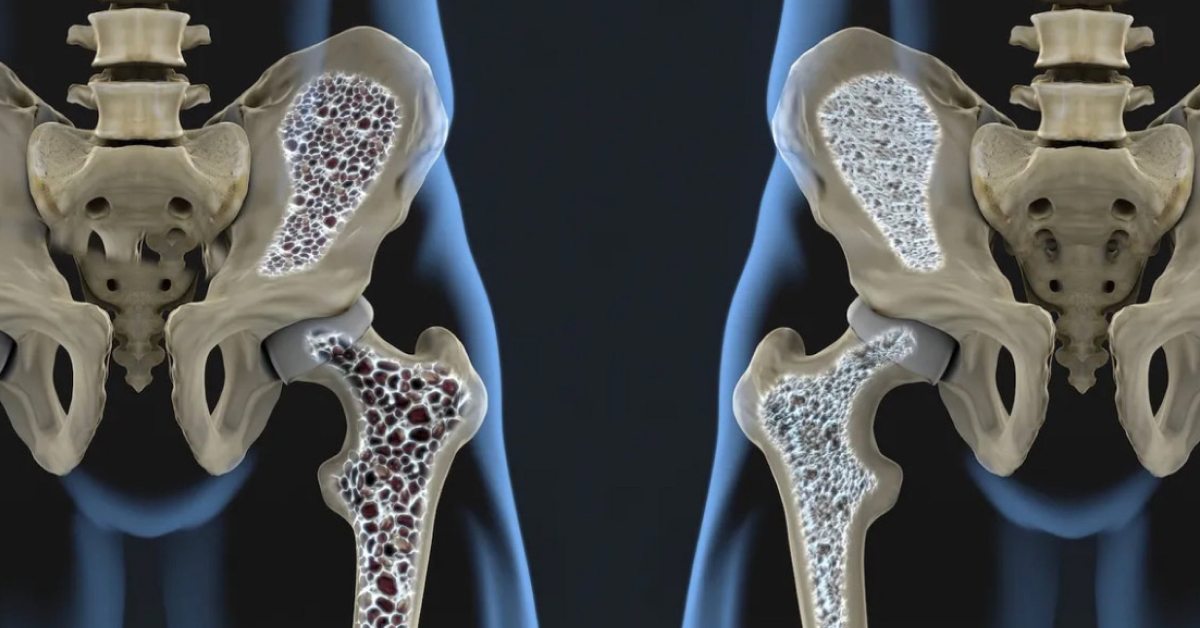 ultrazvučno mjerenje gustine kostiju