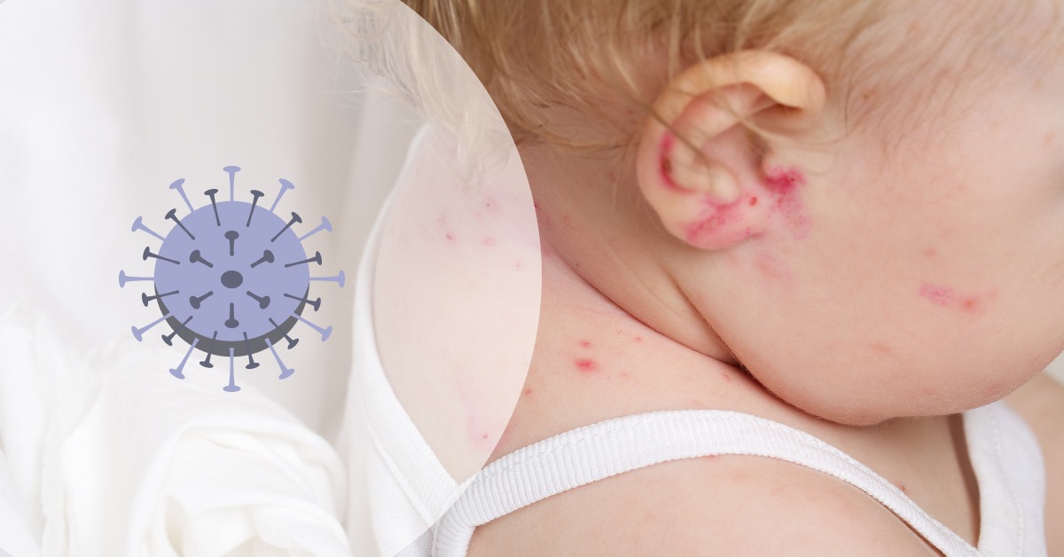 virus boginja uzročnik infekcije