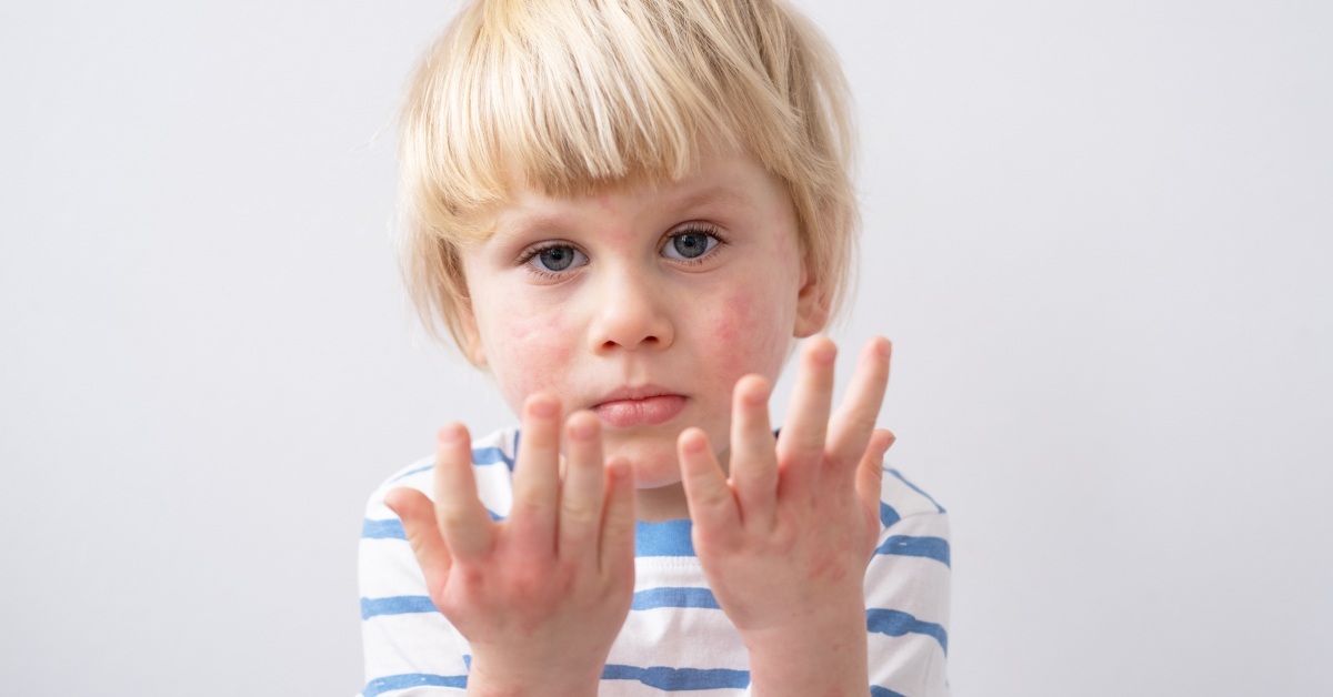 celijakija kod djece