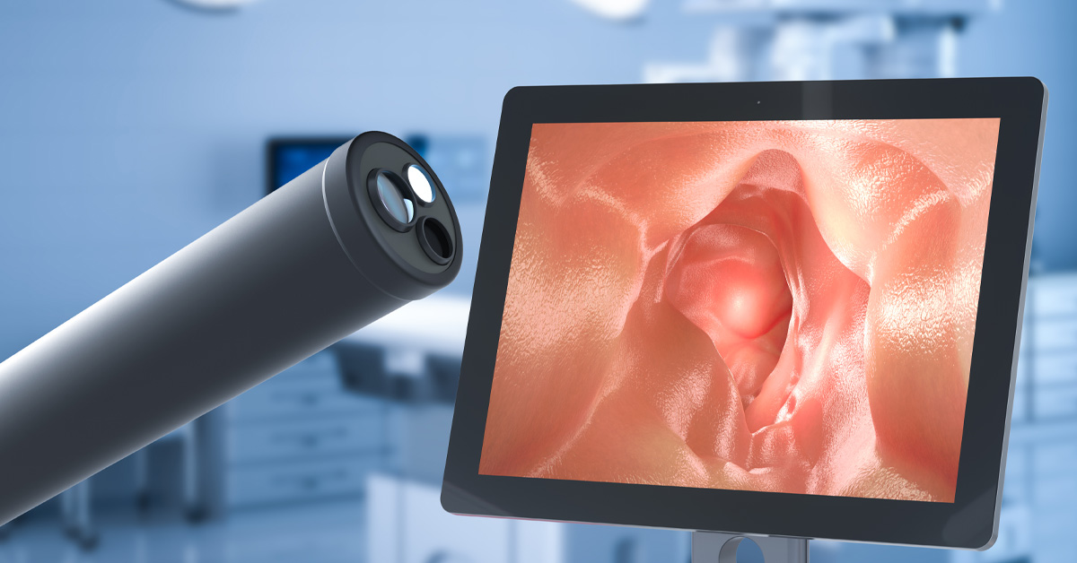 skrining raka debelog crijeva