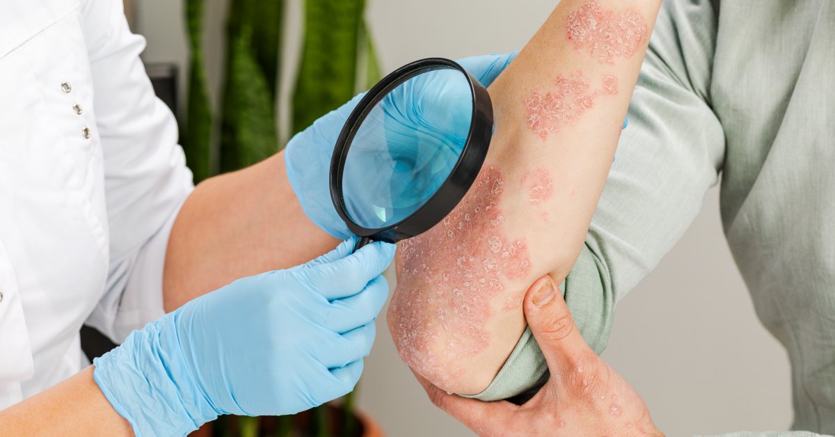 Ljekar pregleda psorijazu na ruci pacijenta