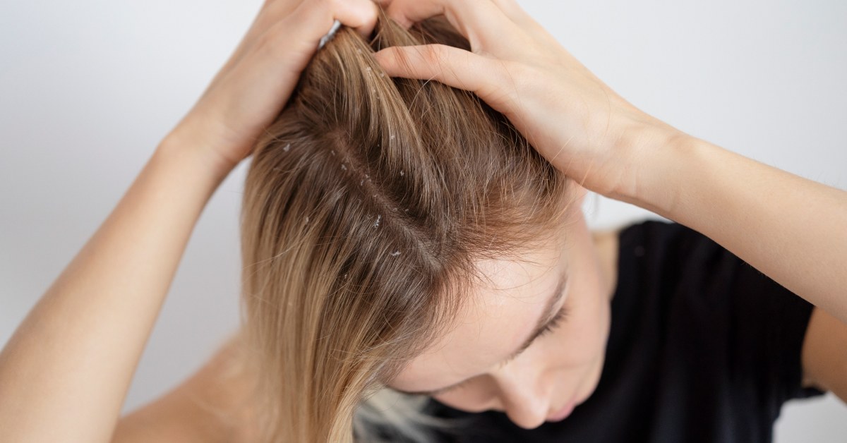 Seboroični dermatitis na vlasištu kod odrasle osobe
