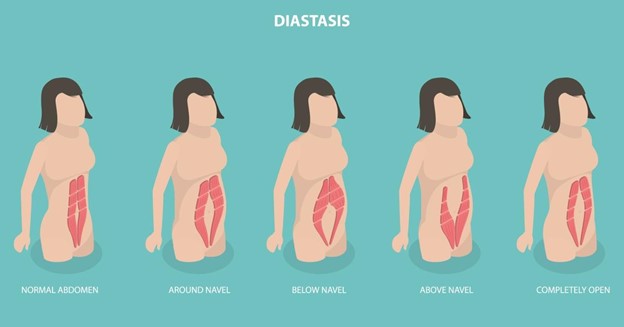 razlika između zdravih i razmaknutih trbušnih mišića