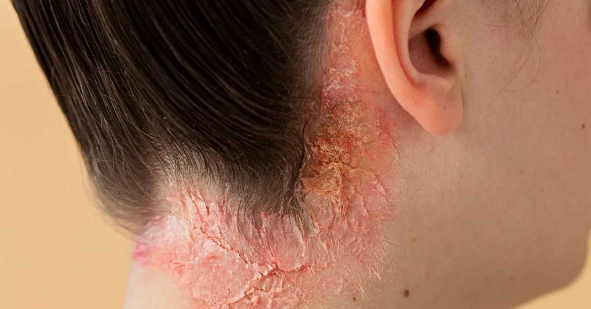 celijakija kod odraslih