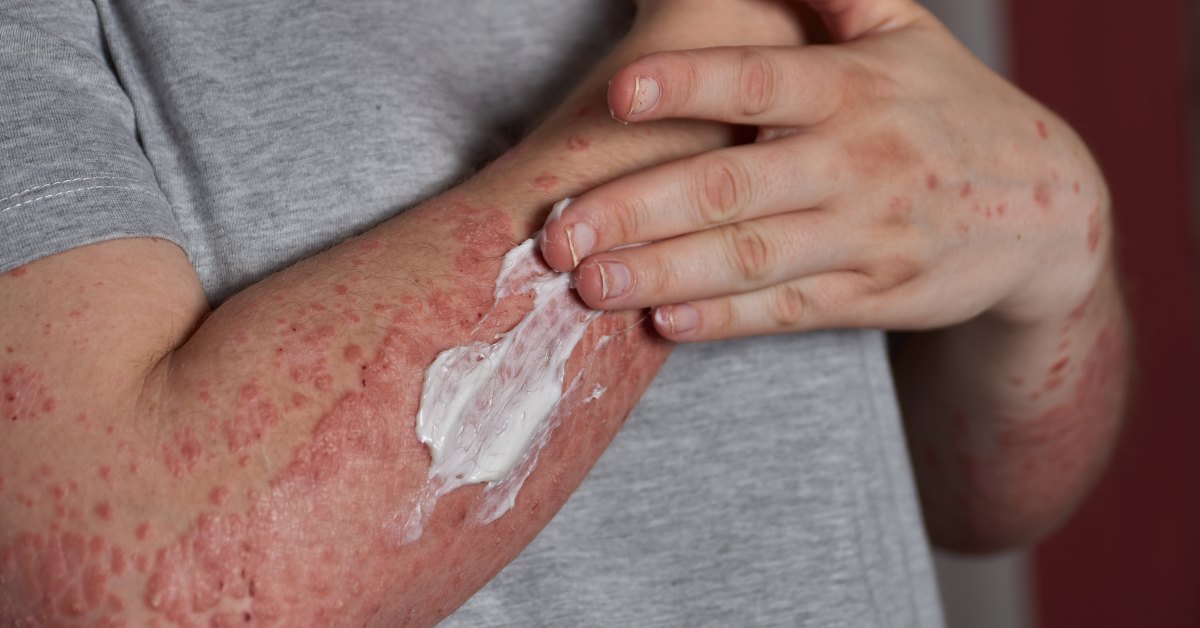 čovek maže kremu na psorijazu na ruci