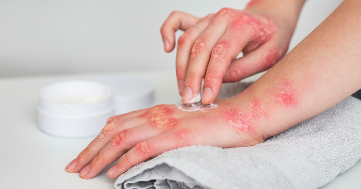 atopijski dermatitis kod odraslih